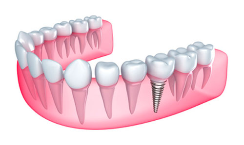Common Misconceptions About Prosthodontics