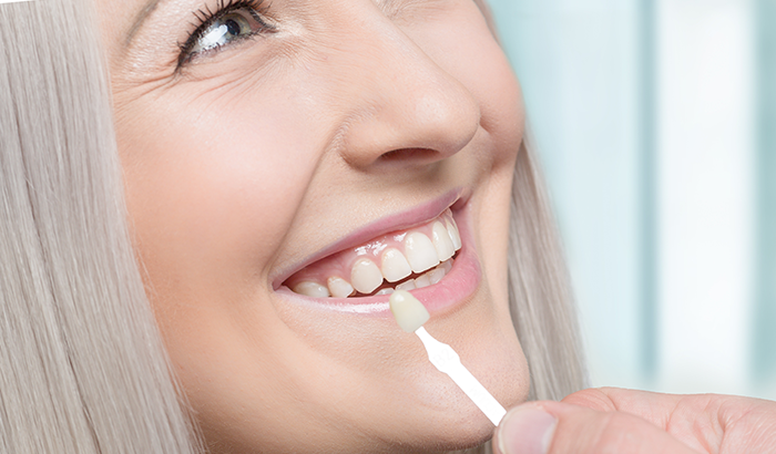 Image of a woman smiling before getting a dental veneer placed in her mouth.