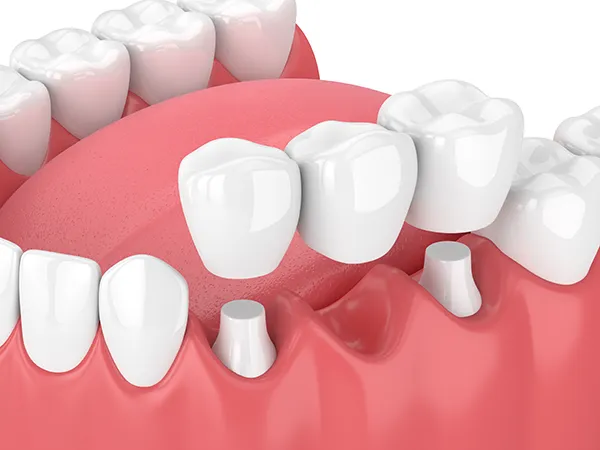 Photo of dental bridge from  St. Louis Prosthodontics in St. Louis, MO