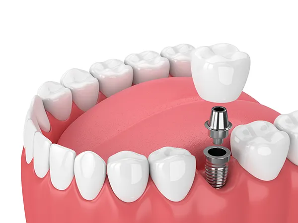 Rendering of jaw with dental implant at St. Louis Prosthodontics in St. Louis, MO.