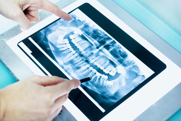 Dental x-ray of a full mouth in St. Louis, MO.