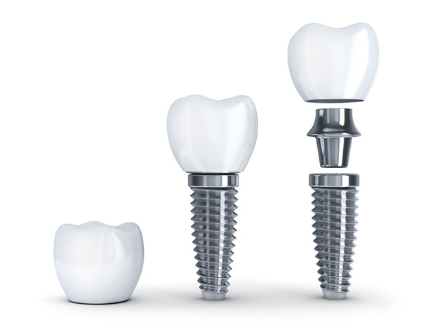 Diagram of dental implant with post. Diagram of dental implant with post.