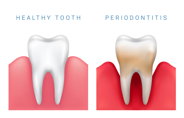 Preventive Prosthodontic Treatments